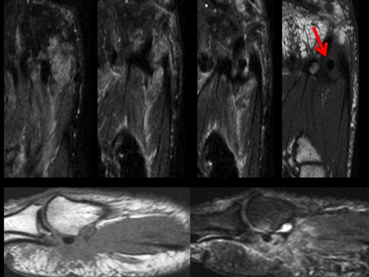 Figure 3 for case calcium hydroxyapatite crystal deposition disease ( RID3594 )